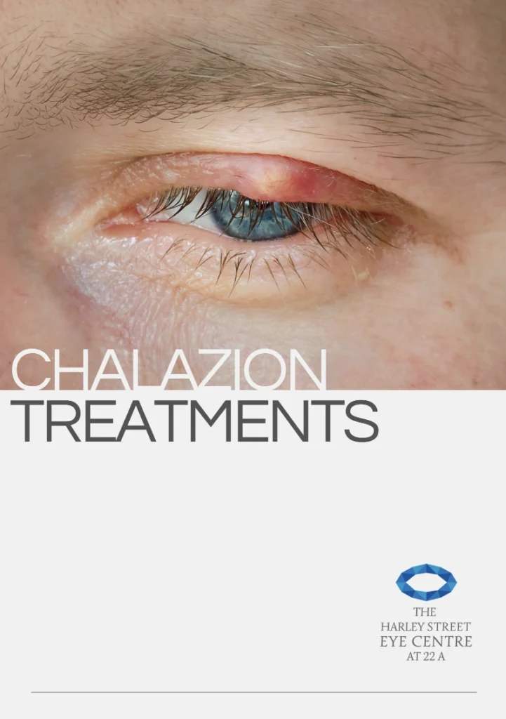 Chalazion Brochure